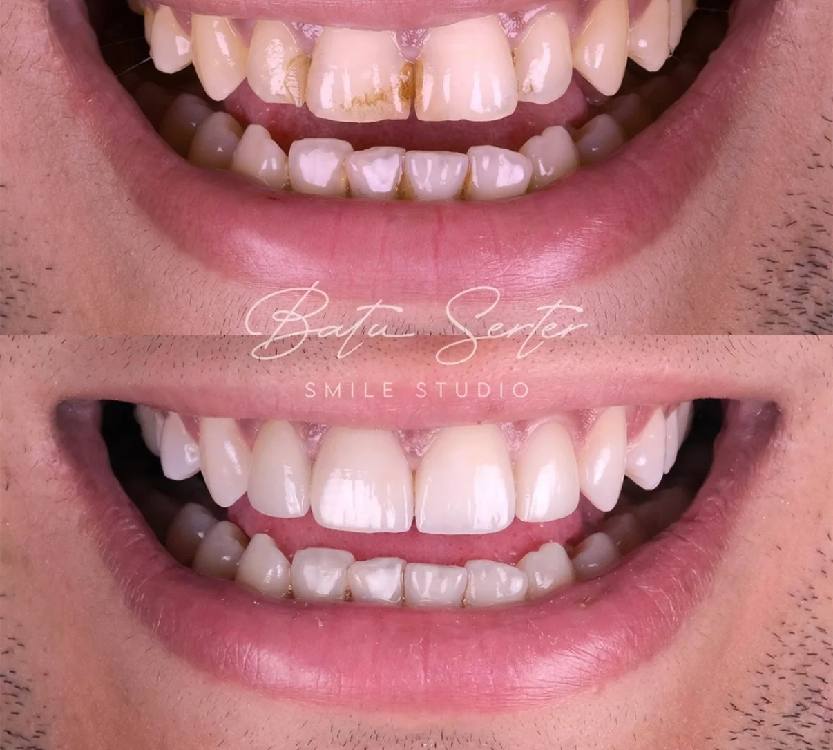 Before / After — Batu Serter Smile Studio