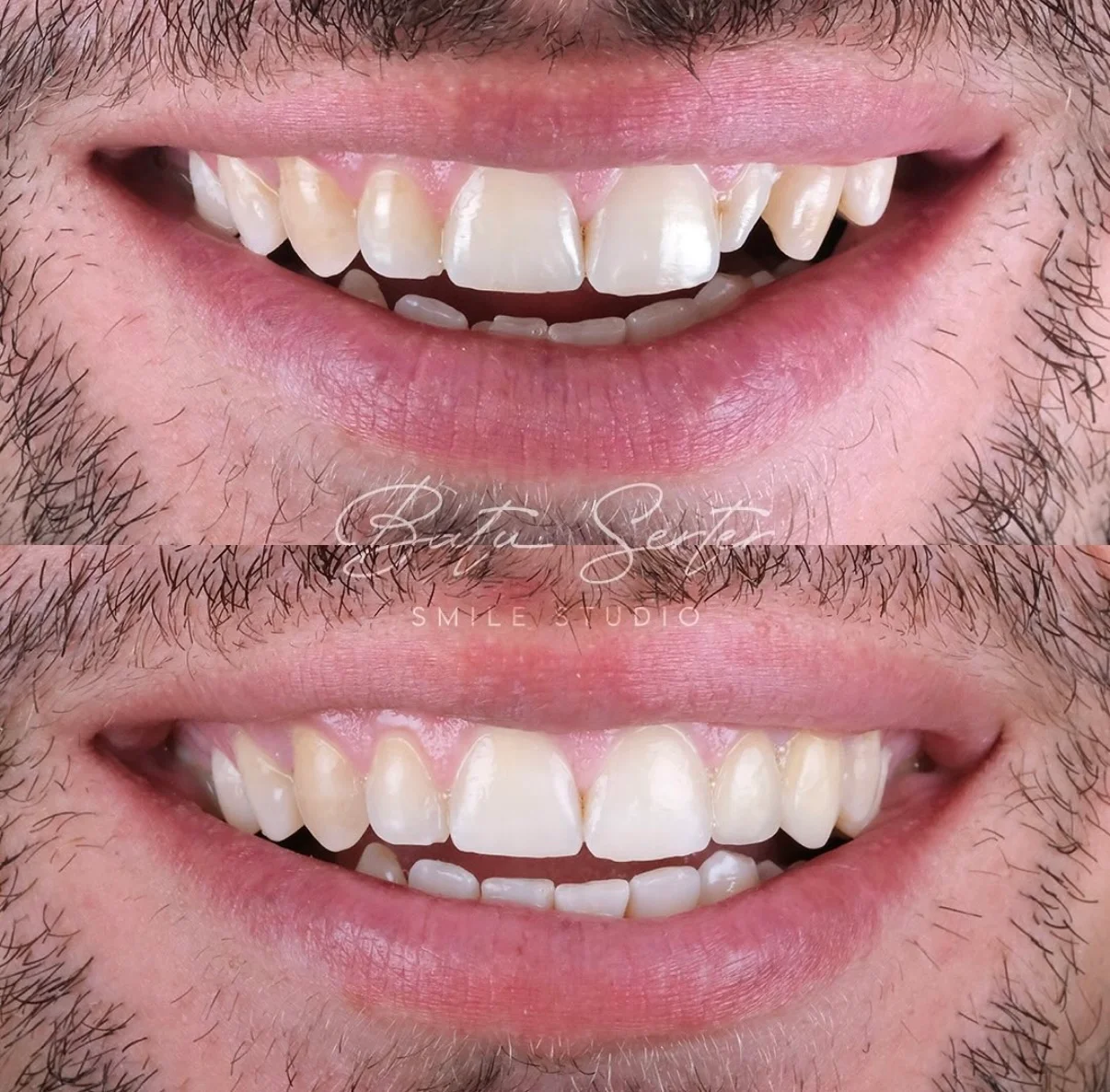 Before / After — Batu Serter Smile Studio