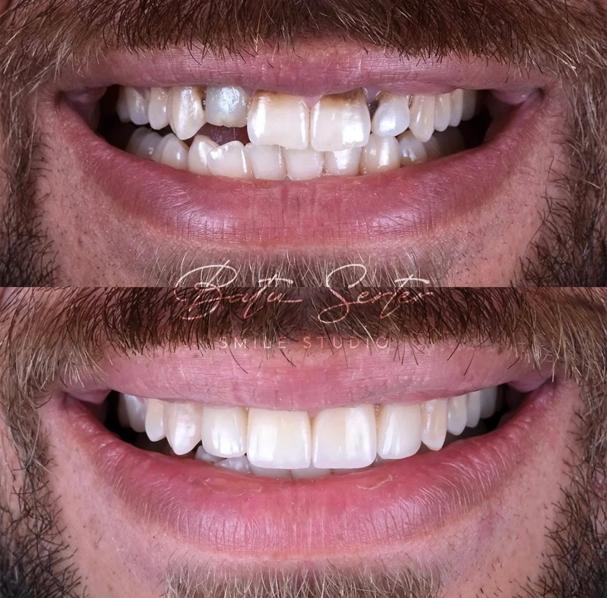 Before / After — Batu Serter Smile Studio