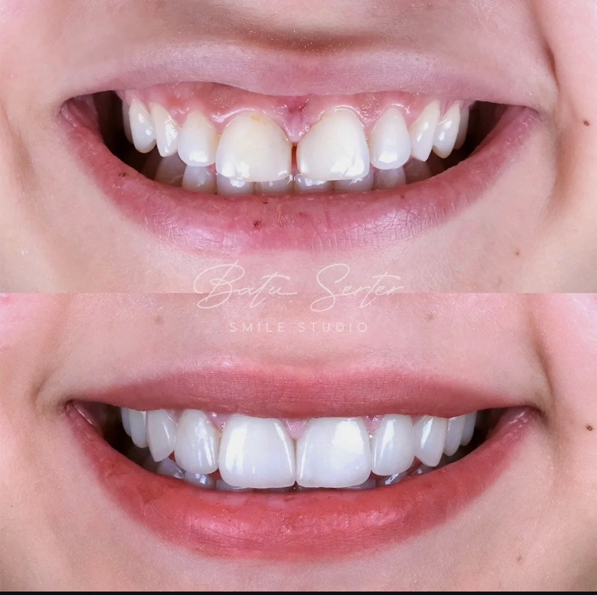 Before / After — Batu Serter Smile Studio