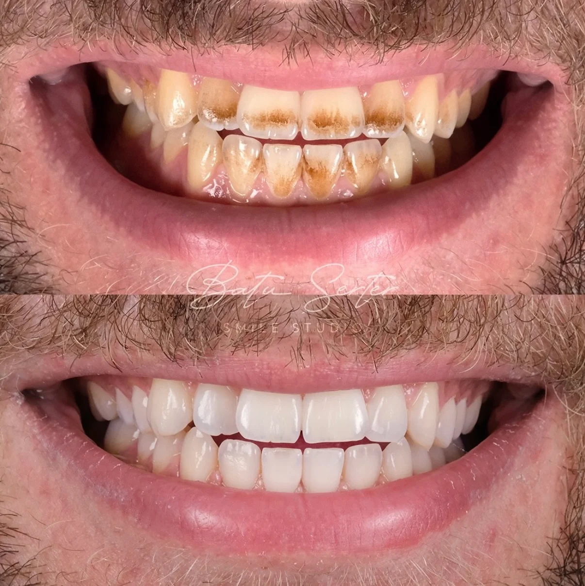Before / After — Batu Serter Smile Studio