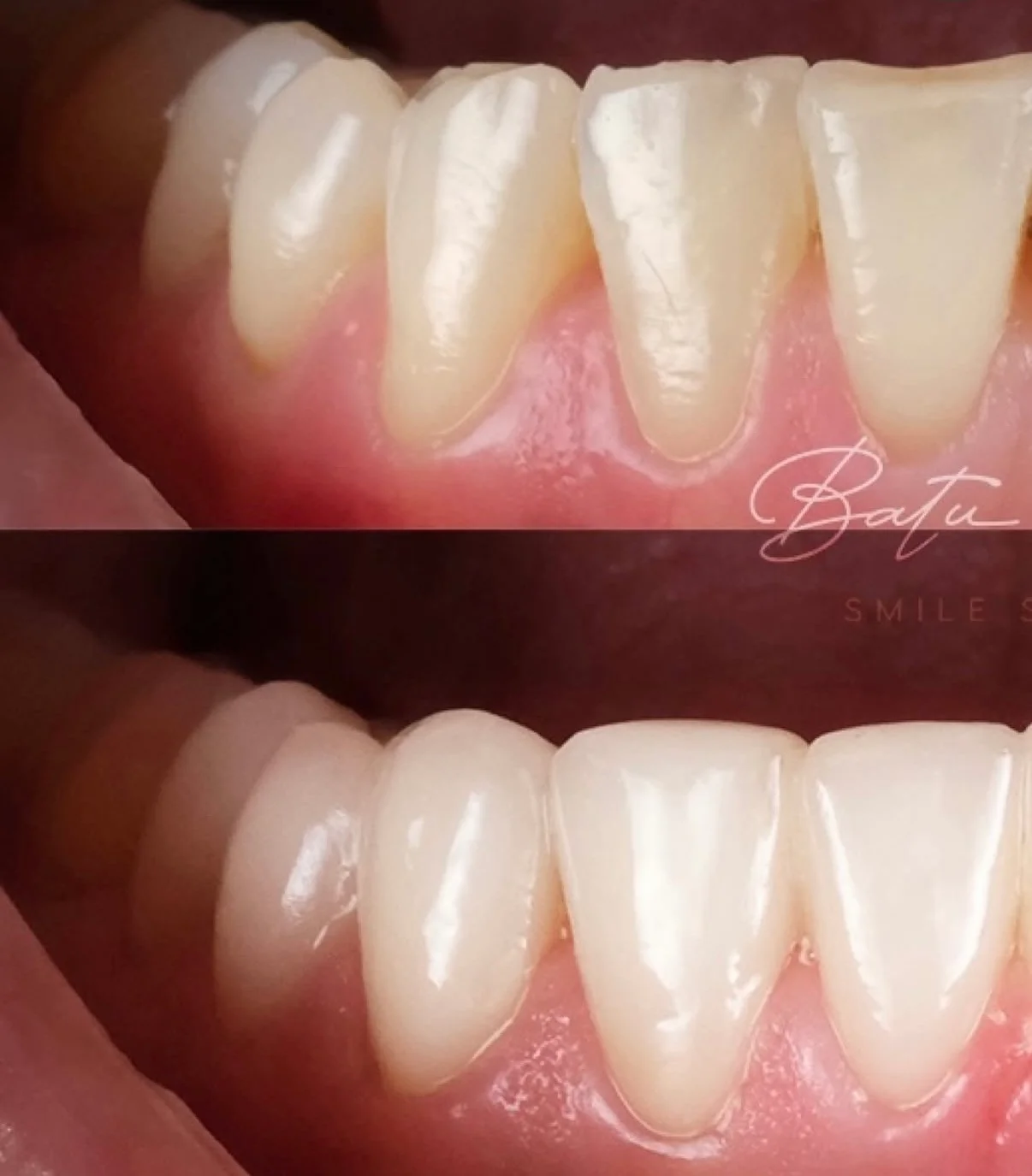 Before / After — Batu Serter Smile Studio