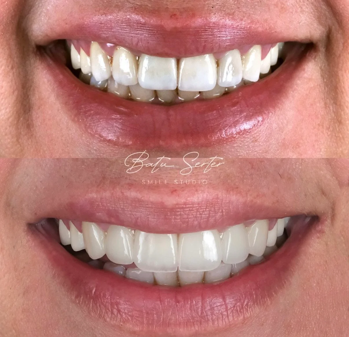 Before / After — Batu Serter Smile Studio