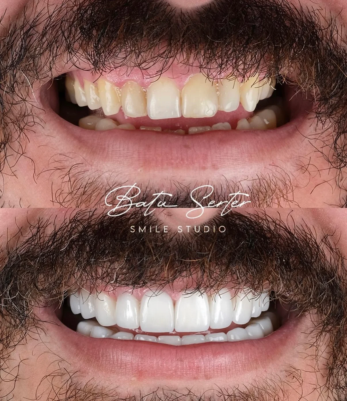 Before / After — Batu Serter Smile Studio