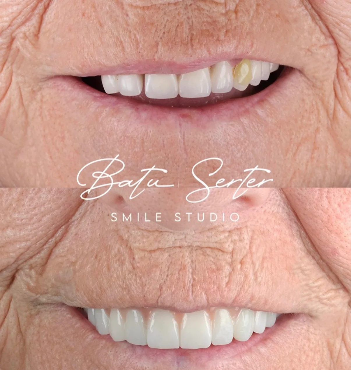 Before / After — Batu Serter Smile Studio