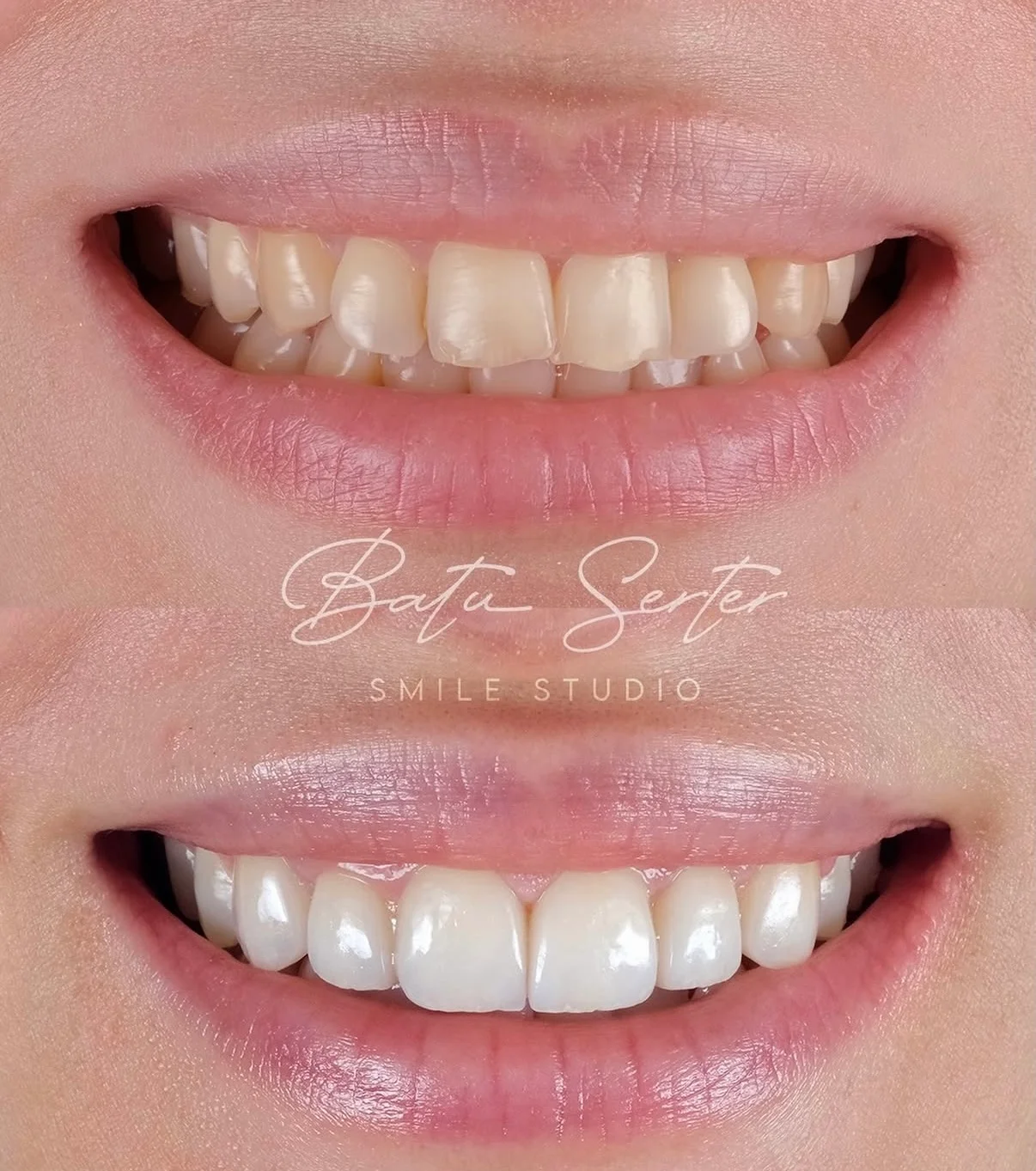 Before / After — Batu Serter Smile Studio